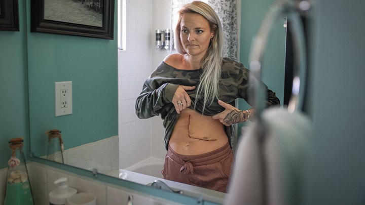 Living donor Amy Hasson shows her incision a week after surgery.