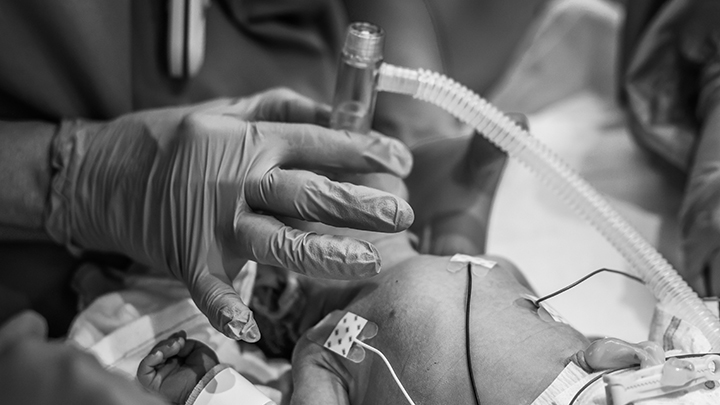 Tiny chest rising and falling, a newborn receives life-sustaining support as the neonatal team works quickly and gently to stabilize.