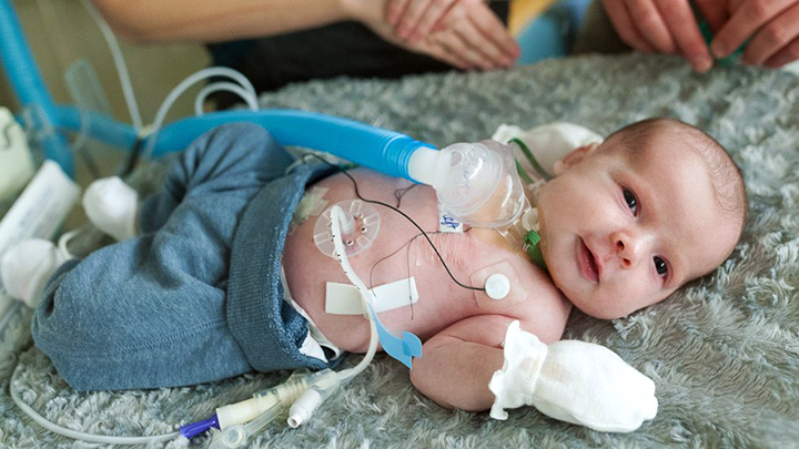 Pediatric Tracheostomy